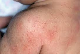 Image result for heat rash baby