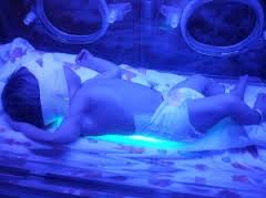 phototherapy-jaundice-newborn-baby